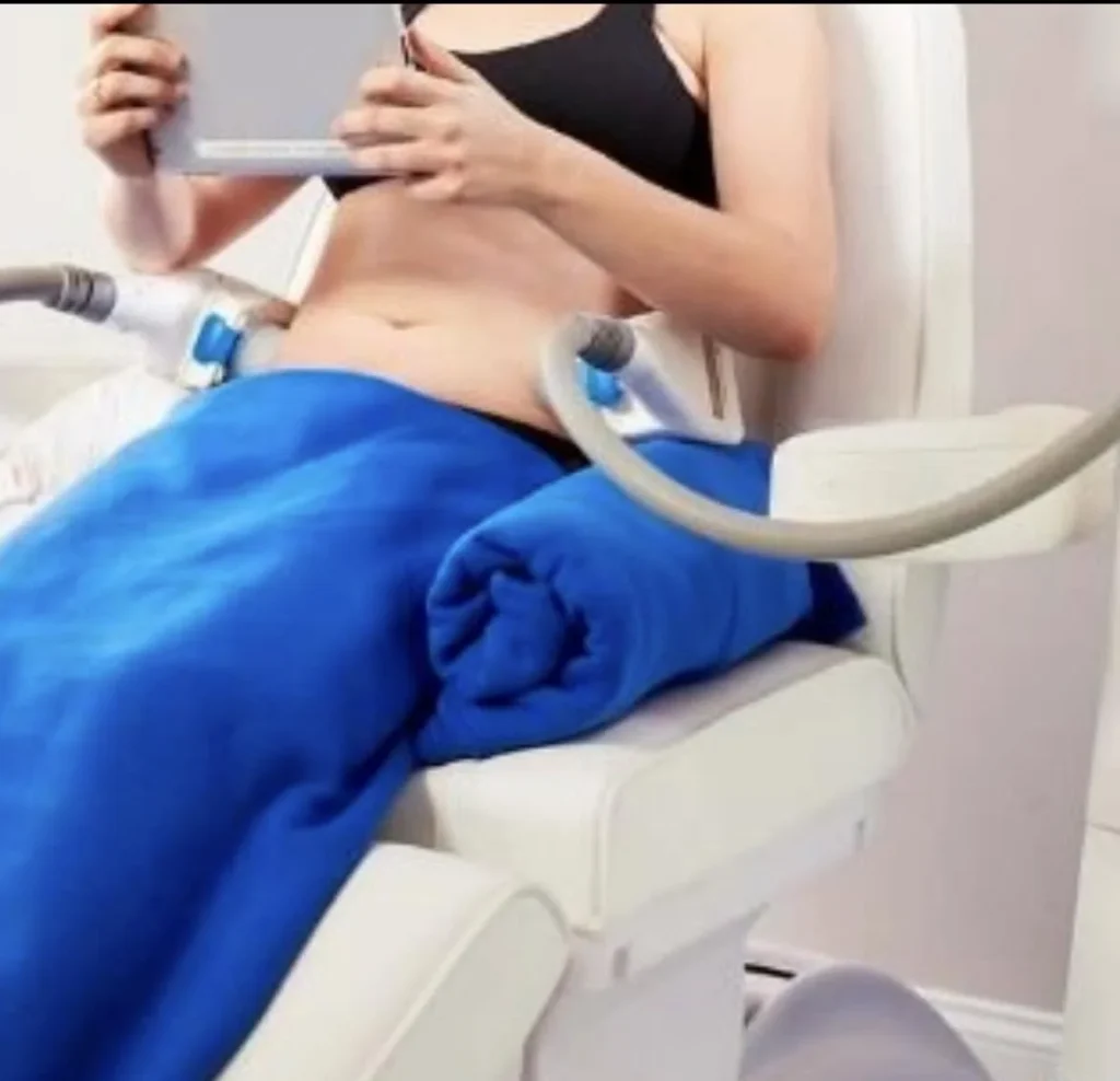 Cryolipolyse (vetbevriezing) op de buik bij Innofit Utrecht